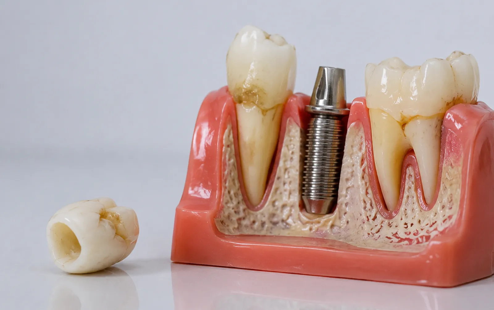 What are Dental Implants